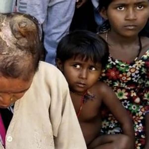 Kobieta z Indii poszukuje pomocy specjalisty. Na jej głowie wyrosły ogromne i bolesne „rogi”