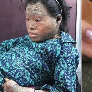 Znaleźli tę dziewczynę z dziwną skórą w szopie. Produkt znany nam na co dzień odmienił jej życie