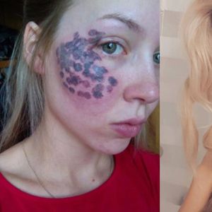 Blogerka została poparzona podczas zabiegu, który można wykonać w większości salonów kosmetycznych!