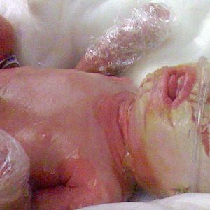 Dziecko rodzi się pokryte grubymi, białymi płatami skóry. 5 lat później wygląda zupełnie inaczej…