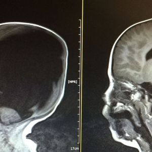 Urodził się z zanikiem mózgu. Gdy lekarze po 3 latach prześwietlili jego głowę, uznali to za cud
