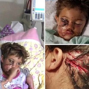 5-latka została zaatakowana przez dwa pitbule. Jej mama w akcie desperacji osłoniła ją swoim ciałem