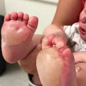 Mama zauważa bąble na stopach córeczki. Jest przerażona, gdy dowiaduje się, co zrobiła opiekunka