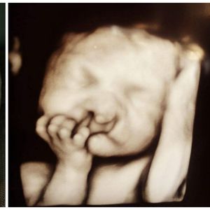 Lekarze proponowali aborcję, ale rodzice się nie zgodzili. Chłopiec urodził się z dużą deformacją.