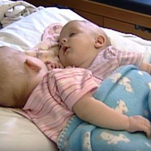 10 lat temu te syjamskie bliźniaczki zostały rozdzielone. Dzisiaj trudno jest je rozpoznać