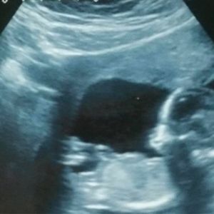 Lekarz zaproponował kobiecie aborcję. Ona się nie zgodziła i urodziła wyjątkową dziewczynkę