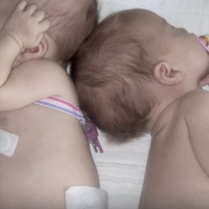 U 2-miesięcznej dziewczynki lekarz wykrył guza. Gdy zbadał jej siostrę bliźniaczkę, przeżył szok