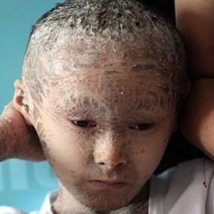 11 wyjątkowych dzieci, które z powodu swoich rzadkich chorób stały się znane na całym świecie