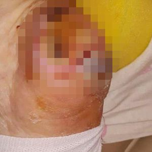 Skandal w elbląskim szpitalu! Kobietę z odleżynami do kości wypisano ze szpitala