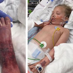 Ciało 7-latki pokryły sine plamy. Gdy mama zabrała ją do szpitala, usłyszała druzgocącą diagnozę