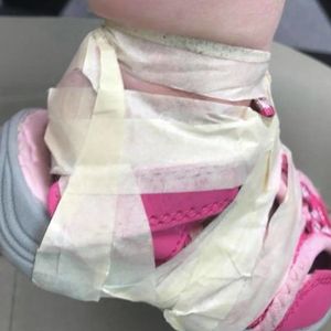 Przedszkolanki przykleiły jej do stóp buciki. 17-miesięczna dziewczynka płakała z bólu