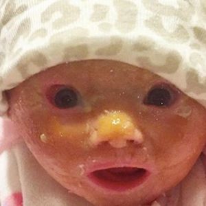 Kiedy się urodziła, jej skórę pokrywała dziwna warstwa. Mama nie była gotowa na diagnozę