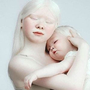 zdjęcia sióstr z albinizmem