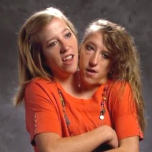 Najsłynniejsze bliźniaczki syjamskie. 31-letnie siostry pragną mieć dzieci