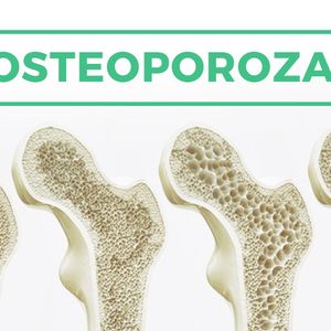 Osteoporoza – przyczyny, objawy i leczenie