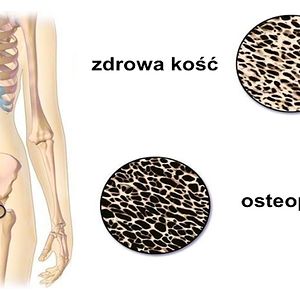 9 naturalnych sposobów na osteoporozę. Dzięki nim będziesz mieć zdrowe kości