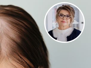 Szczerze opowiedziały o problemach z łysieniem. "Miałam koszmary, że spada mi peruka"