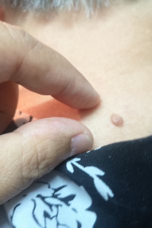 Domowe sposoby na leczenie kurzajek. Co działa, a co może zaszkodzić?