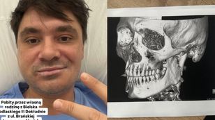 Daniel Martyniuk oskarżył rodzinę o pobicie, pokazując opuchniętą twarz