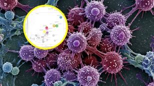 Sztuczna inteligencja w walce z rakiem. Algorytm przewiduje ryzyko przerzutów