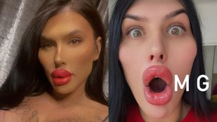 Chce mieć największe usta na świecie. Lekarze odmawiają jej kolejnych zabiegów (FOTO)