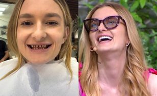 Reality TV star Joanna Osypowicz gets "Turkish teeth" despite dentists' warnings