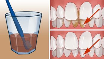 Te domowe metody pomogą Ci pozbyć się nieestetycznego kamienia nazębnego, a dodatkowo wybielą zęby