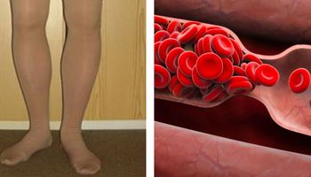 8 znaków ostrzegawczych, które mogą świadczyć o zakrzepie krwi. Ta wiedza może uratować życie!