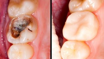 5 prostych i naturalnych kroków na zapobieganie próchnicy i dziurom w zębach. Żegnajcie plomby!