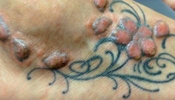 3 długoterminowe zagrożenia wynikające ze zrobienia sobie tatuażu. Można się przestraszyć!