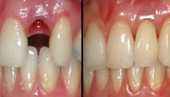 Dentyści znaleźli sposób na „wyhodowanie” nowych zębów zaledwie w 9 tygodni. Śmiały krok!