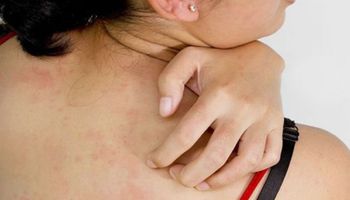 7 domowych środków, które pomogą Ci w leczeniu alergii skórnej. Czerwone plamy i świąd znikną!