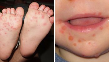 Dziecięca choroba HFMD jest często źle diagnozowana. Atakuje dłonie, stopy i jamę ustną
