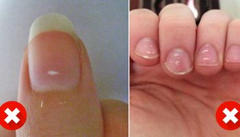 Białe plamy na paznokciach są poważnym sygnałem, którego lepiej nie ignorować