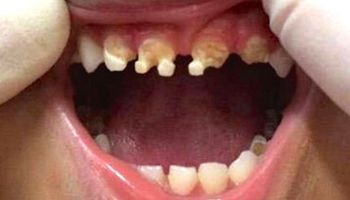 Dentysta był przerażony, gdy zobaczył zęby 3 latka. Wszystko przez popularny napój