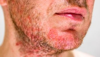 Łojotokowe zapalenie skóry – Jakie daje objawy i jak sobie z nim radzić?