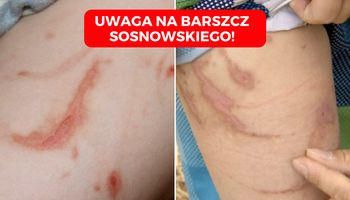 Barszcz Sosnowskiego zbiera żniwo wśród dzieci. Przypadki poparzenia II i III stopnia