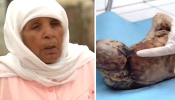 84-latka nosiła skamieniały płód przez 44 lata. Nie miała o tym pojęcia