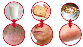 6 produktów, które rujnują Twoją skórę. Bez tej wiedzy nie pozbędziesz się trądziku