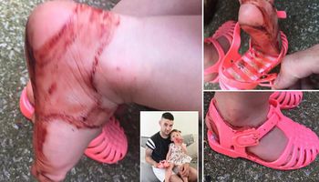 Dziewczynka ubrała gumowe sandały. Po kilku godzinach mama zauważyła, że z jej stóp cieknie krew!