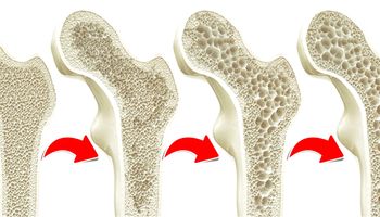 Osteoporoza to plaga XXI wieku. Przybliża Cię do niej aż 9 nawyków!