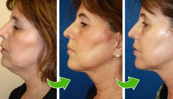 6 skutecznych sposobów na pozbycie się zwiotczałej skóry z twarzy i szyi. Młodszy wygląd!
