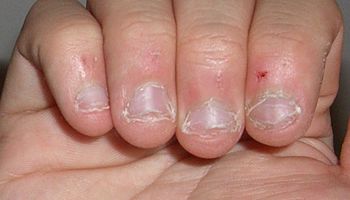 6 przykrych konsekwencji obgryzania paznokci. Skuteczny odstraszacz