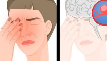Tętniak mózgu często mylony jest z migreną. Ból jest nie do odróżnienia