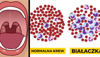 W Polsce co pół godziny ktoś dowiaduje się, że ma białaczkę. Często ujawnia się poprzez anginę