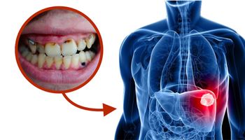 Jama ustna a rak wątroby – zły stan zębów i dziąseł zwiększa ryzyko choroby o 75%!