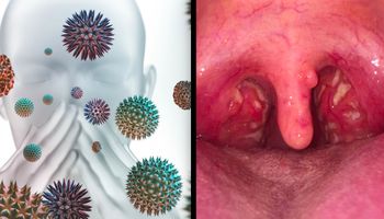 Zespół alergii jamy ustnej – co to jest, jak się objawia i czy można go wyleczyć?