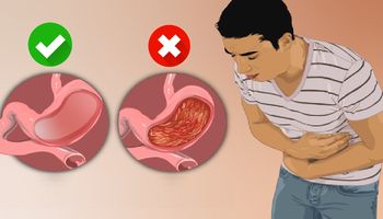 10 objawów zapalenia błony śluzowej żołądka. Cierpi na nie miliony Polaków