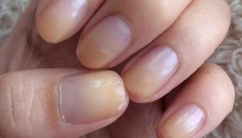 6 skutecznych sposobów na walkę z różnymi zmianami na Twoich paznokciach