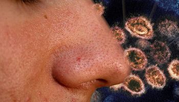 Badania nosa i gardła ujawniły, dlaczego chorzy na koronawirusa mogą tracić węch